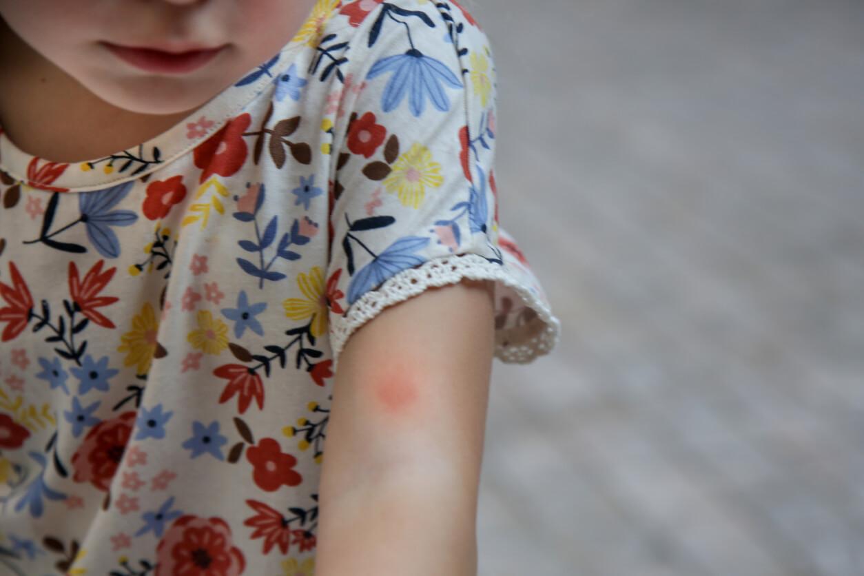 Bug bites often result in itchy red bumps or rashes on the skin. This is because the saliva or venom of the bug that bit you causes an allergic reaction in your body.