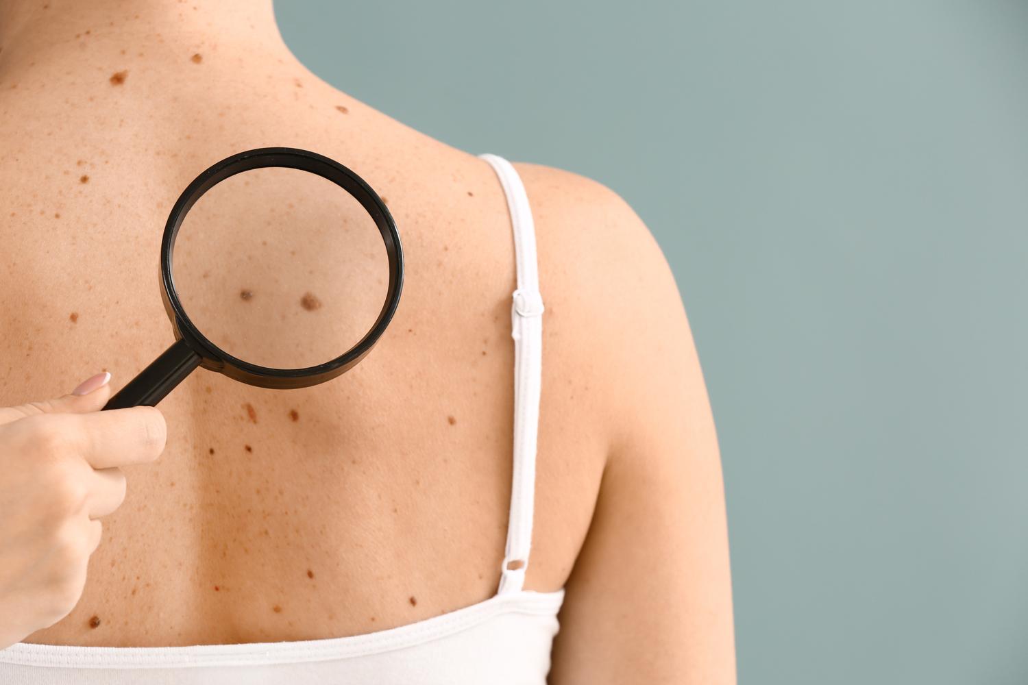 An estimated one in five Americans will develop skin cancer in their lifetime. Here's what you need to know about skin cancer causes, detection and prevention.