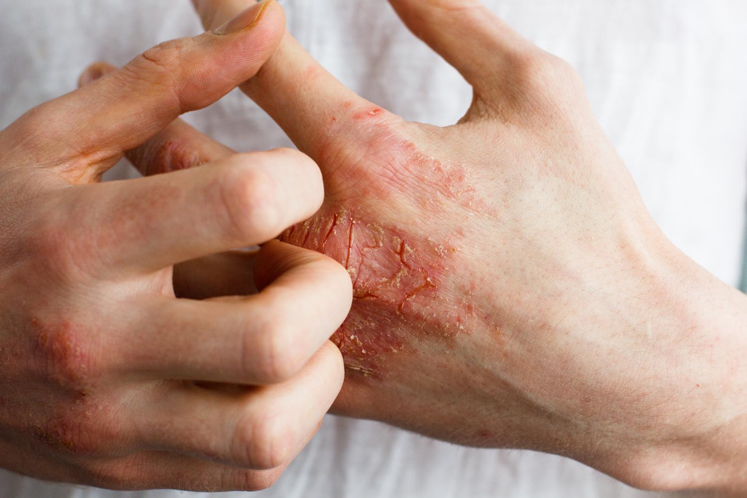 Explore the differences between eczema and psoriasis, two chronic skin conditions. Discover their symptoms, causes and various treatment options to help manage these conditions effectively.