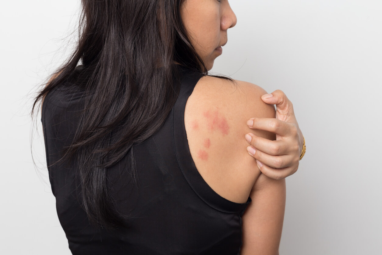 Skin rashes caused by stress are sometimes known as “stress hives”. Read on to learn everything you need to know about this uncomfortable skin condition.