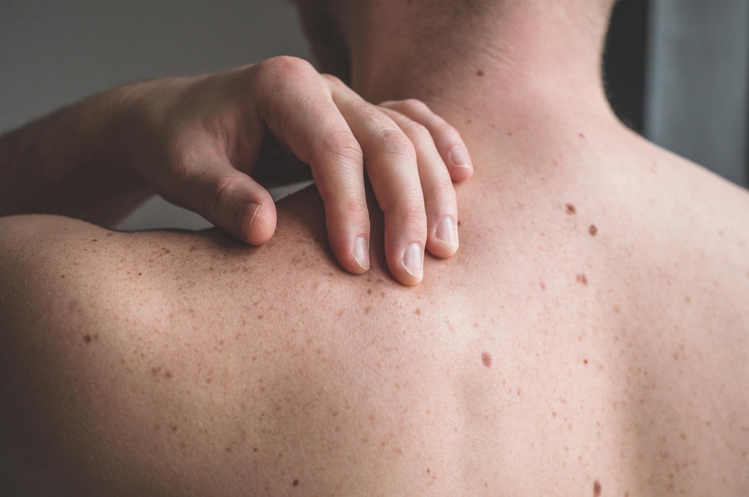 It’s so important to know the signs of skin cancer and treat it quickly. In this blog, we'll discuss the different types of skin cancer, along with 10 key signs and symptoms to be aware of.