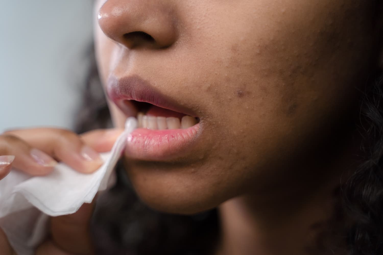 You cannot cure cold sores, but you don’t have to suffer from symptoms. Learn more about prescription and OTC medication and home remedies to treat cold sores.