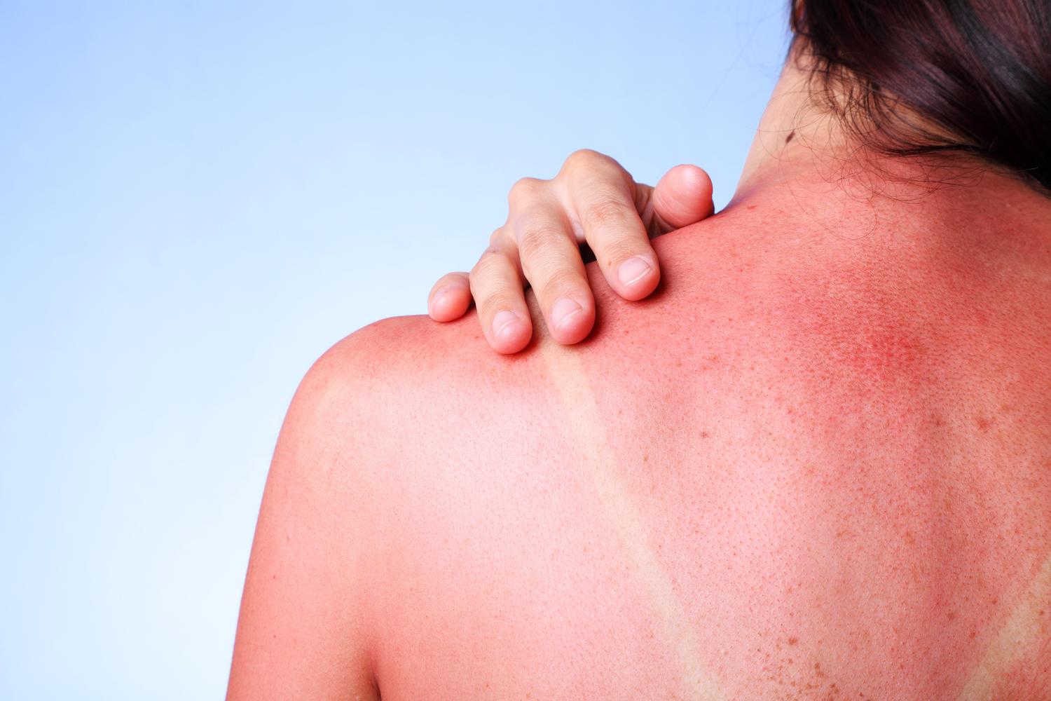 Around a third of Americans report getting sunburned each year. Common as sunburns are, they're also painful and can cause long-term damage to your skin. Read on for treatment and prevention tips to help keep your skin protected now and into the future
