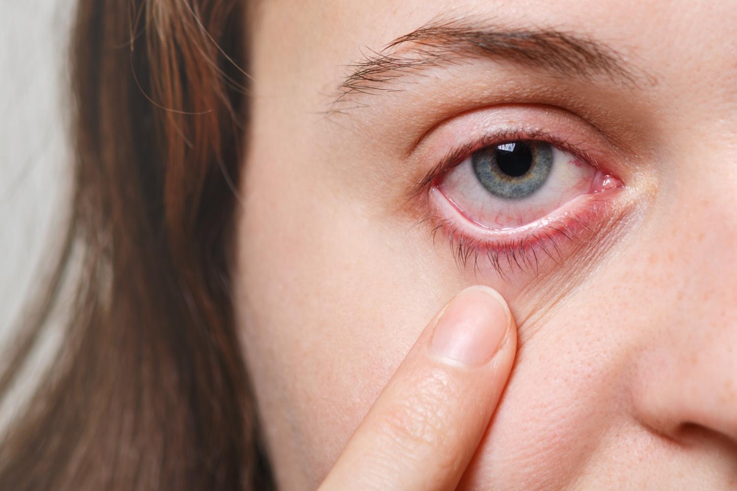 The human eye is an extremely sensitive organ that interacts with a number of systems in the body, so there are a myriad of reasons why someone might experience bloodshot eyes.