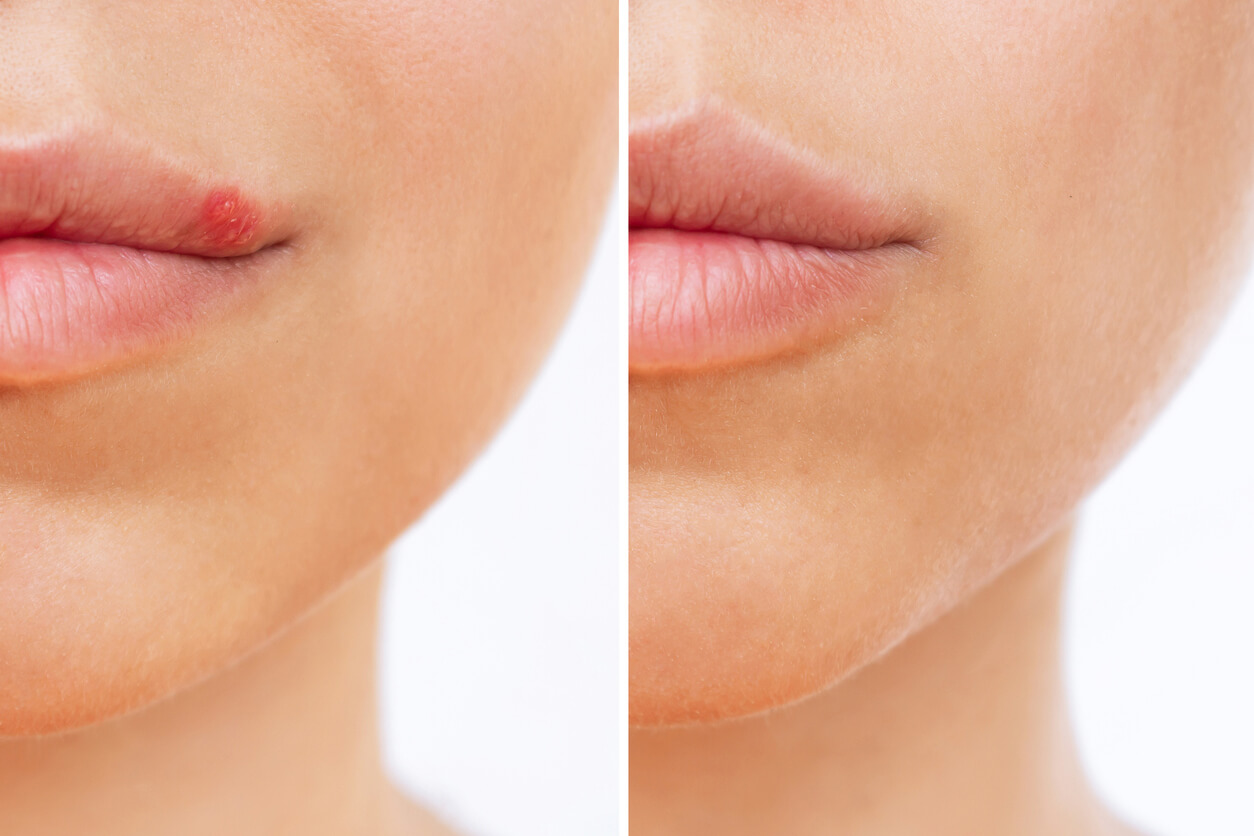 You cannot cure cold sores, but you don’t have to suffer from symptoms. Learn more about prescription and OTC medication and home remedies to treat cold sores.