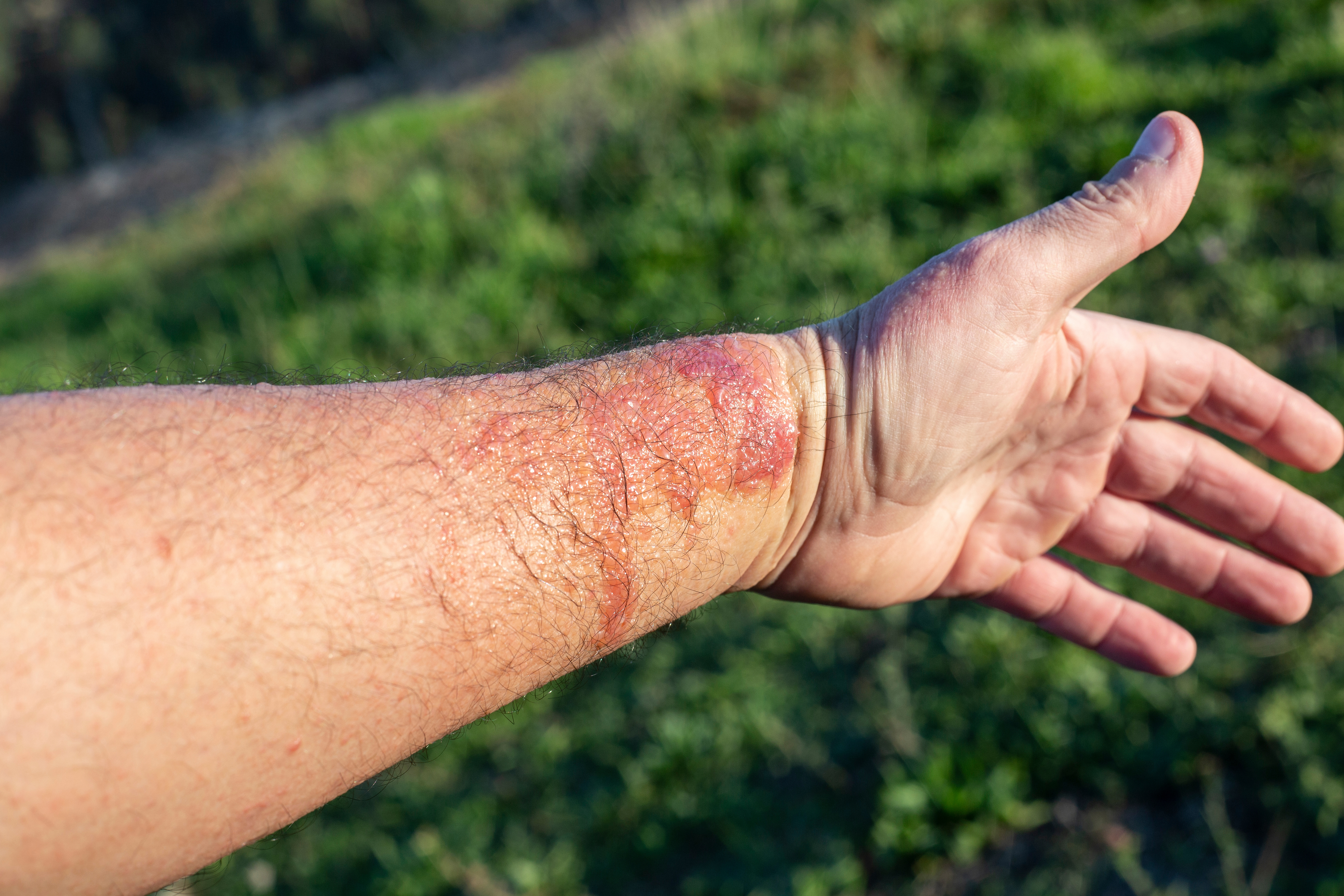 Learn how to treat and prevent rashes and blisters from margarita burn (phytophotodermatitis), a painful skin reaction caused by citrus and sun exposure.