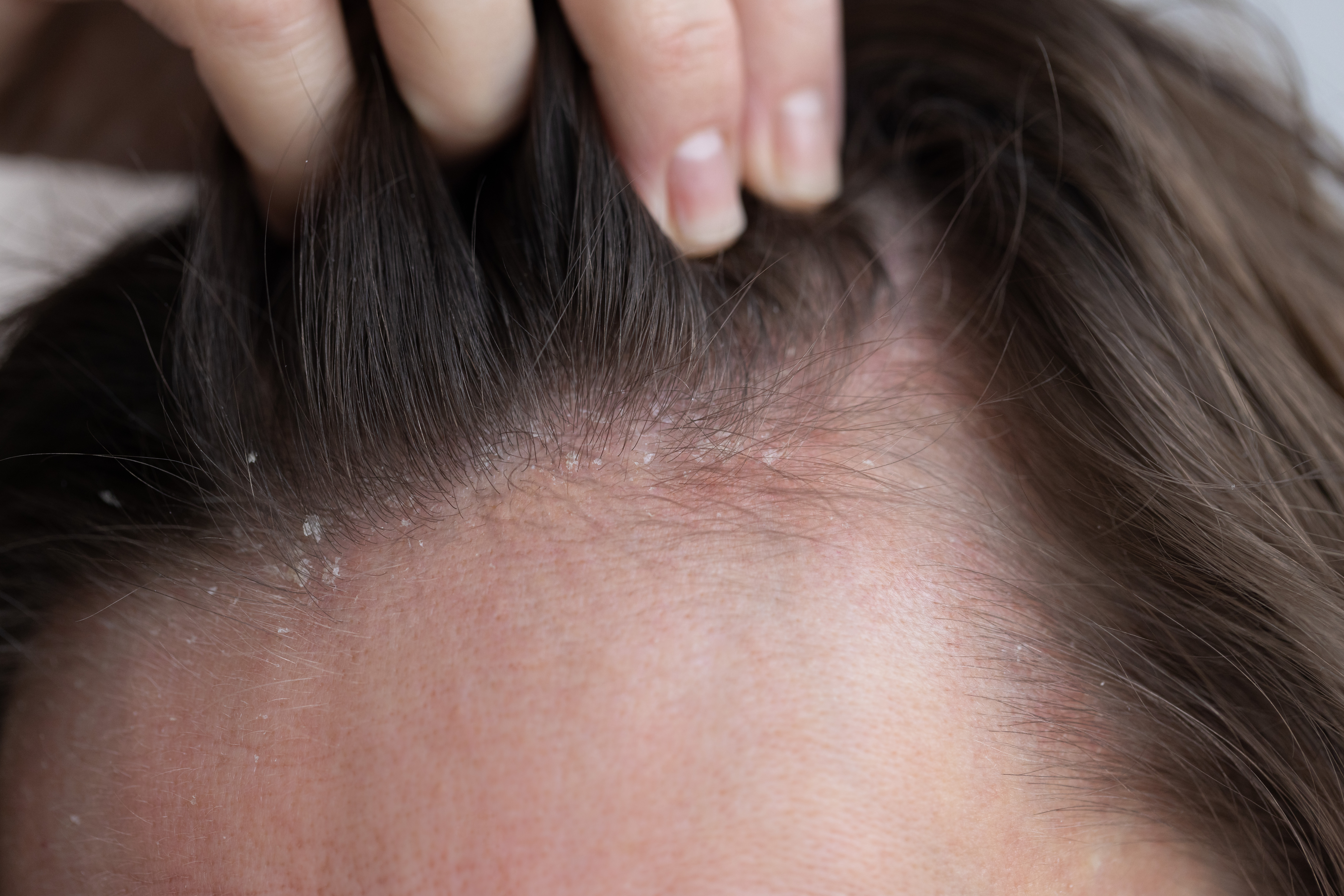 Not sure whether dandruff or scalp psoriasis is causing your flaky scalp? Learn how to tell the difference, along with treatment options, and prevention tips.