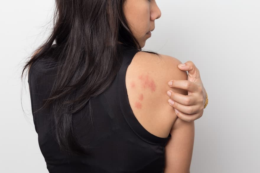 5 Recommended Heat Rash Treatments for Fast Relief