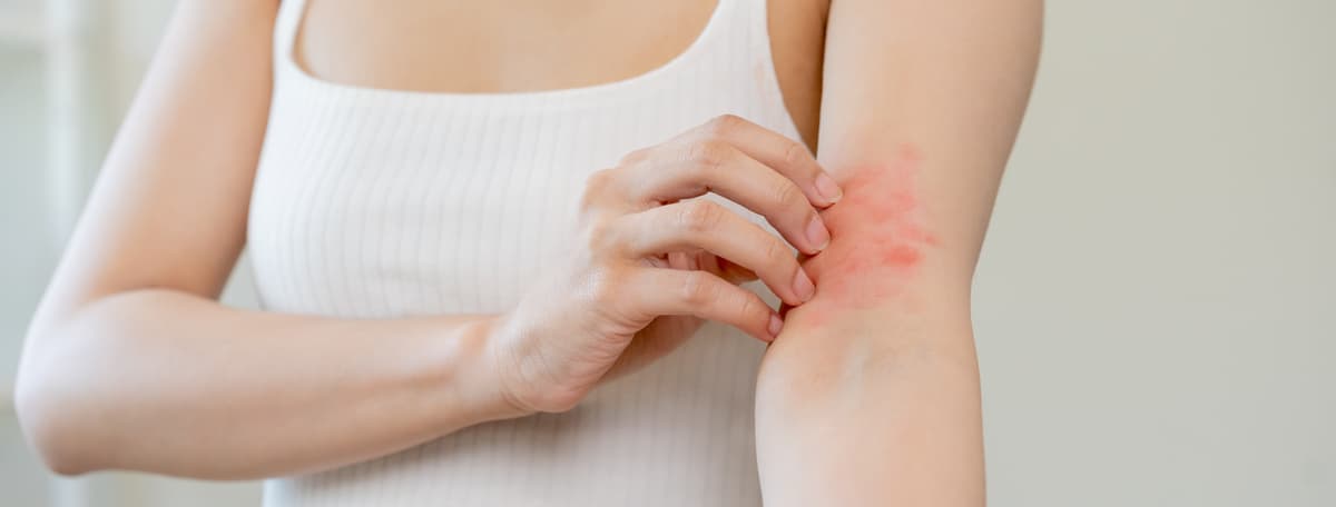 Button Raksho Bug Bite Relief: How to Treat Itching, Stinging & More